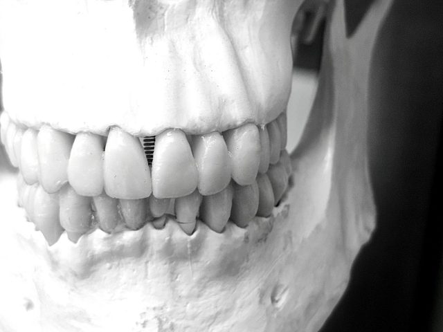 Un nouvel implant contre l’apnée du sommeil testé à Montpellier
